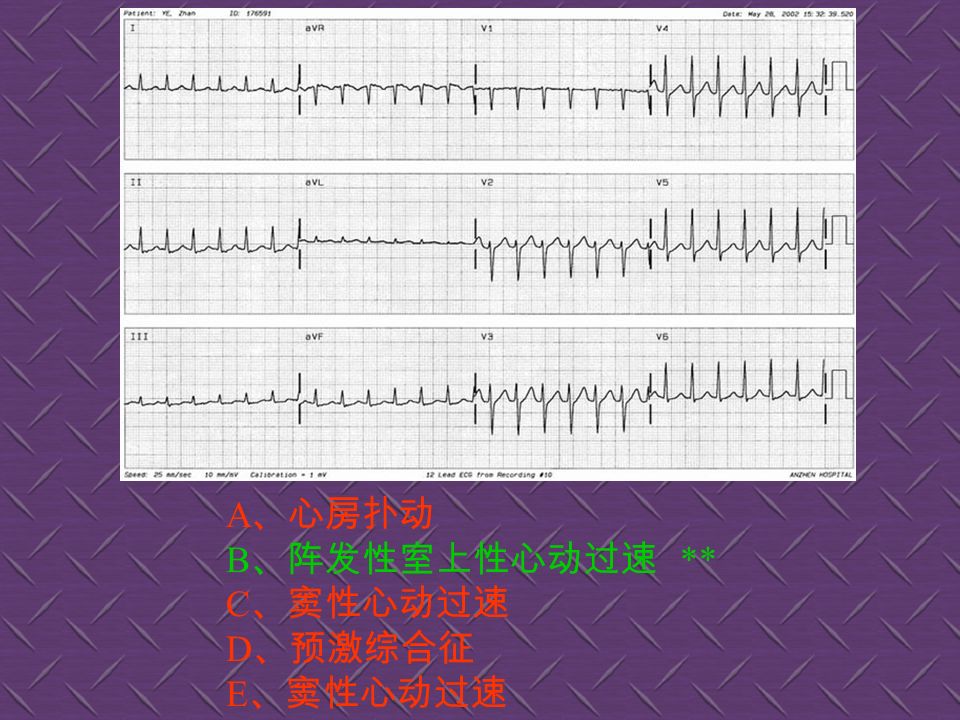 A 、左心室肥厚 ** B 、左束枝传导阻滞 C 、右心室肥厚 D 、右束枝传导阻滞 E 、大致正常心电图