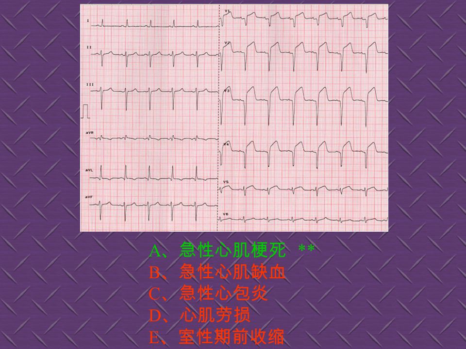 A 、急性心肌梗死 B 、心肌缺血 ** C 、左心室肥大 D 、预激综合征 E 、右心室肥厚
