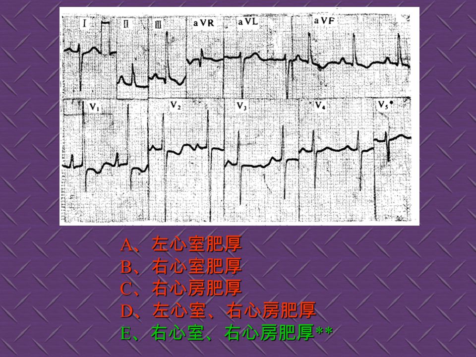 A 、急性心肌梗死 ** B 、急性心肌缺血 C 、急性心包炎 D 、心肌劳损 E 、室性期前收缩