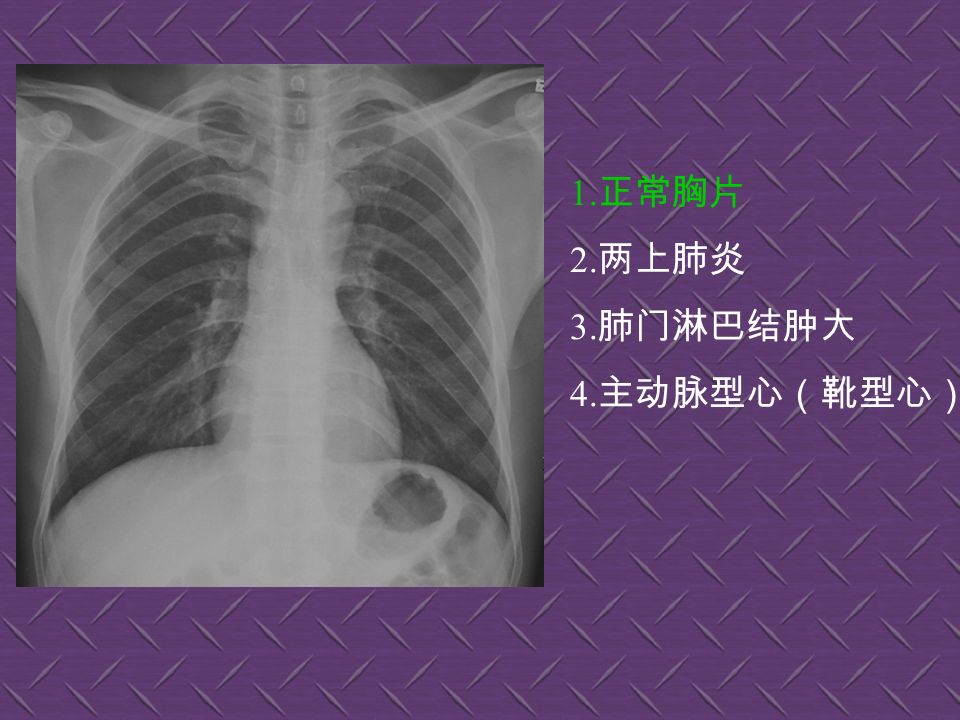 1. 右下肺肺癌 2. 两下肺炎 3. 右肺中叶肺炎 4. 正常胸片