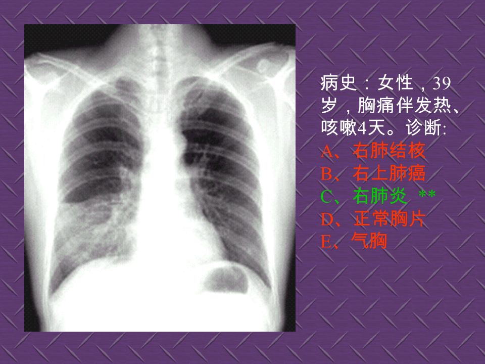 1. 正常胸片 2. 两上肺炎 3. 肺门淋巴结肿大 4. 主动脉型心（靴型心）