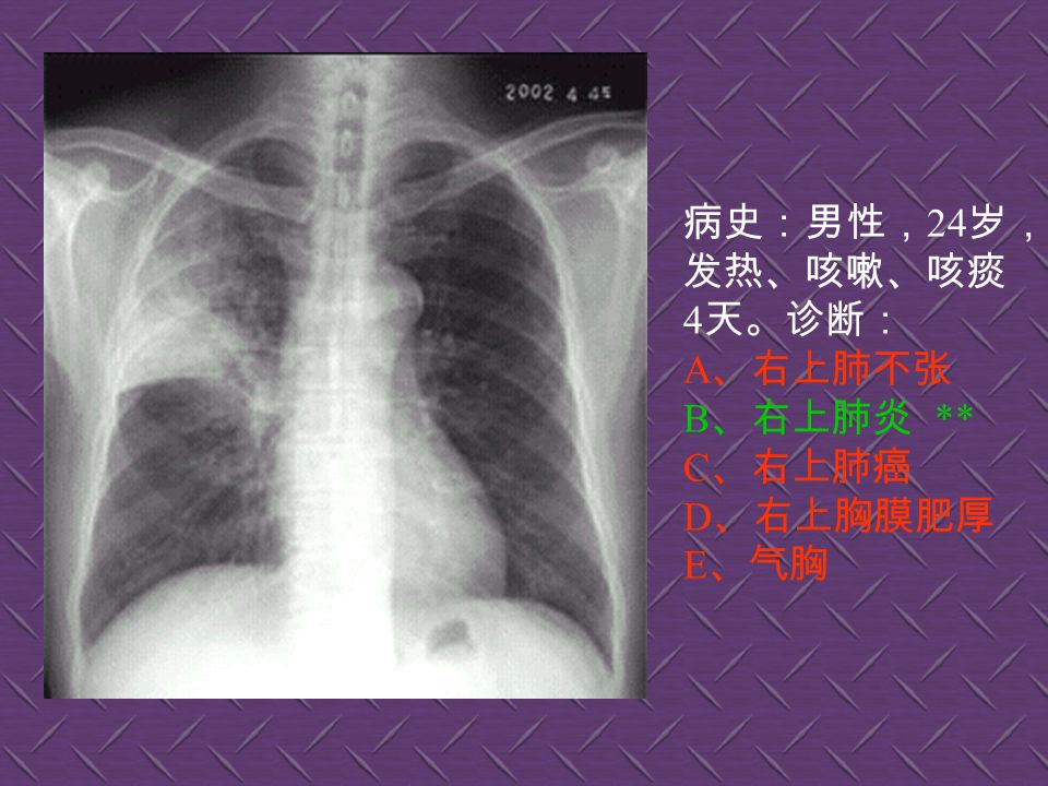 病史：女性， 39 岁，胸痛伴发热、 咳嗽 4 天。诊断 : A 、右肺结核 B 、右上肺癌 C 、右肺炎 ** D 、正常胸片 E 、气胸