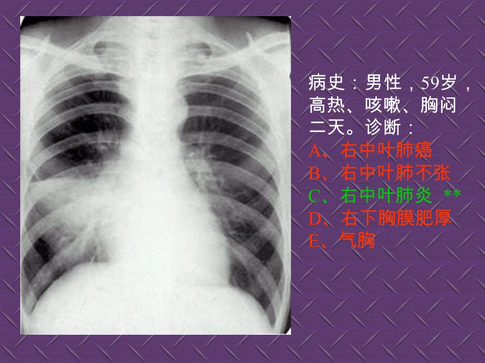 病史：男性， 24 岁， 发热、咳嗽、咳痰 4 天。诊断： A 、右上肺不张 B 、右上肺炎 ** C 、右上肺癌 D 、右上胸膜肥厚 E 、气胸