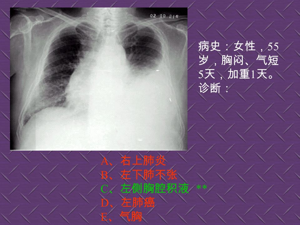 病史：男性， 59 岁， 高热、咳嗽、胸闷 二天。诊断： A 、右中叶肺癌 B 、右中叶肺不张 C 、右中叶肺炎 ** D 、右下胸膜肥厚 E 、气胸