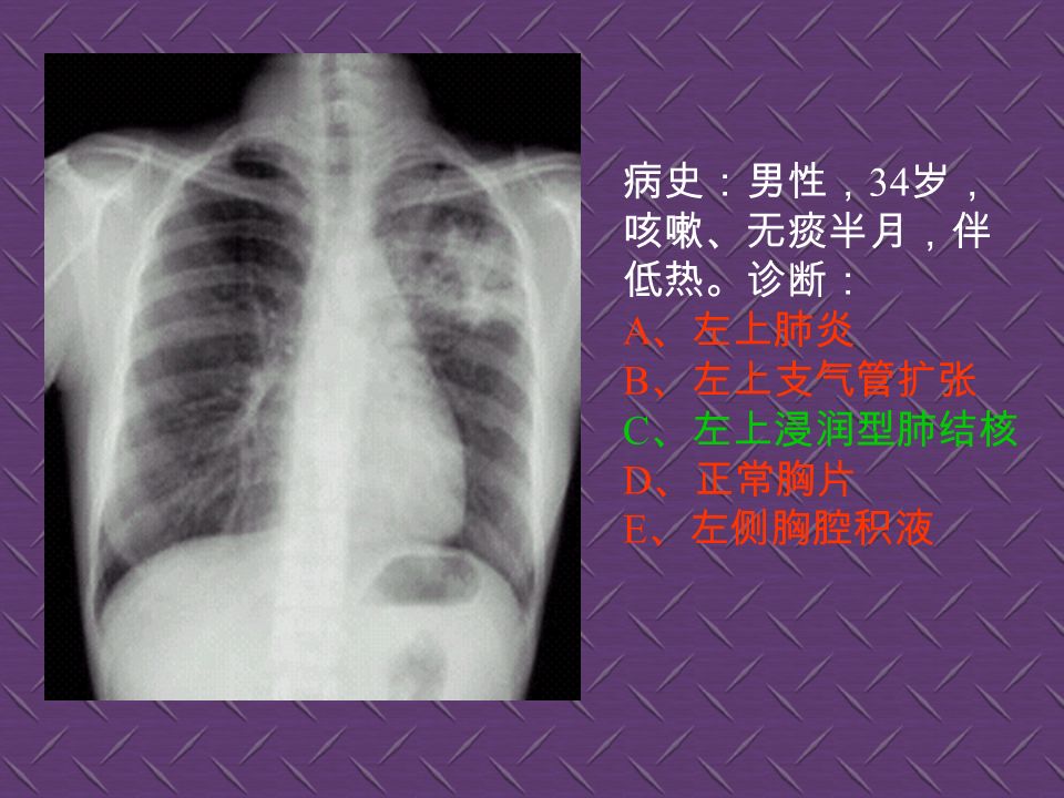 病史：女性， 34 岁， 右侧胸痛、胸闷 1 小 时。诊断： A 、右下肺炎 B 、右侧气胸 ** C 、正常胸片 D 、右下肺气肿 E 、右下胸膜肥厚