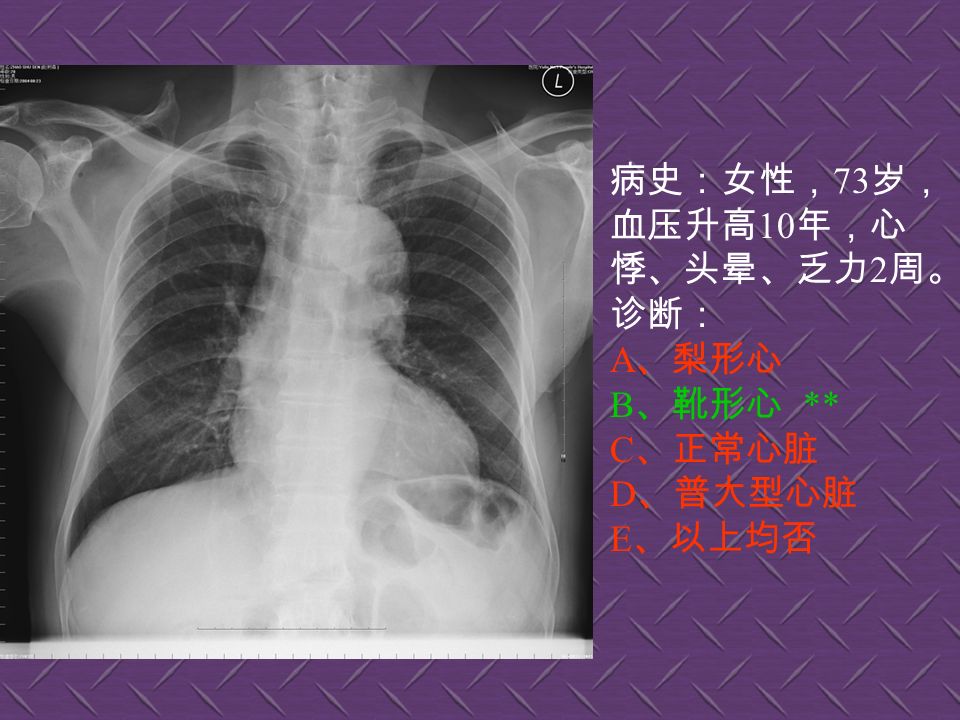 病史：男性， 34 岁， 咳嗽、无痰半月，伴 低热。诊断： A 、左上肺炎 B 、左上支气管扩张 C 、左上浸润型肺结核 D 、正常胸片 E 、左侧胸腔积液
