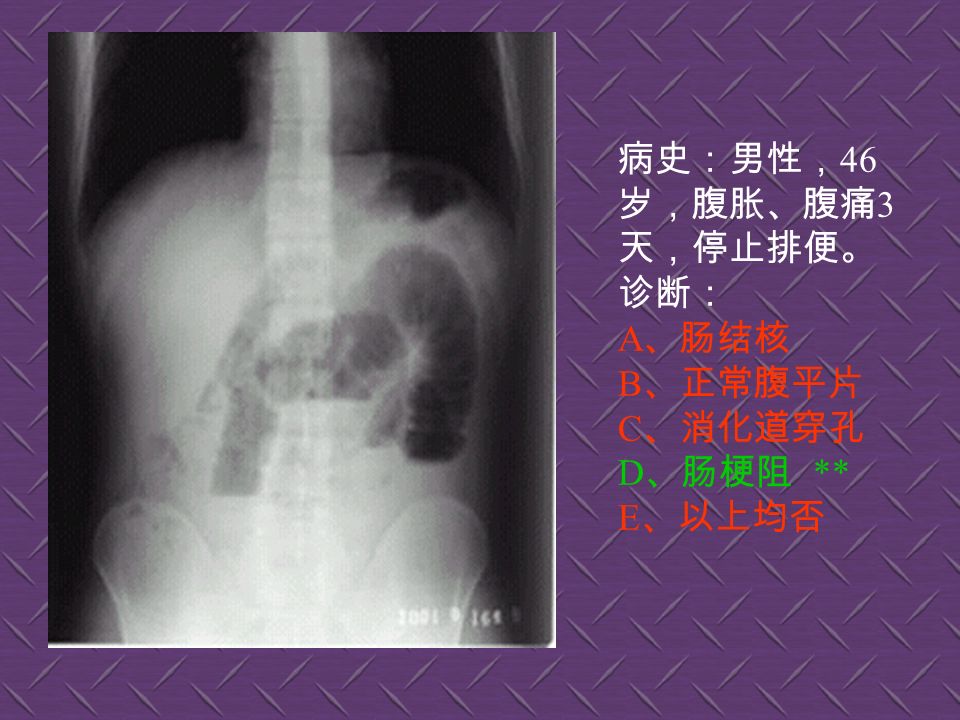 病史：男性， 33 岁， 持续性上腹部不适 1 月。诊断： A 、正常腹平片 ** B 、肠梗阻 C 、消化道穿孔 D 、肠结核 E 、以上均否