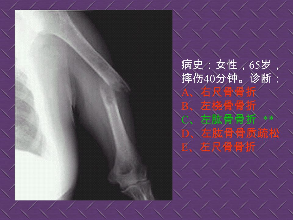 病史：男性， 35 岁， 外伤 30 分钟。诊断： A 、右胫骨骨折 B 、左髋关节脱位 C 、左股骨骨折 * D 、右腓骨骨折 E 、右胫骨骨折