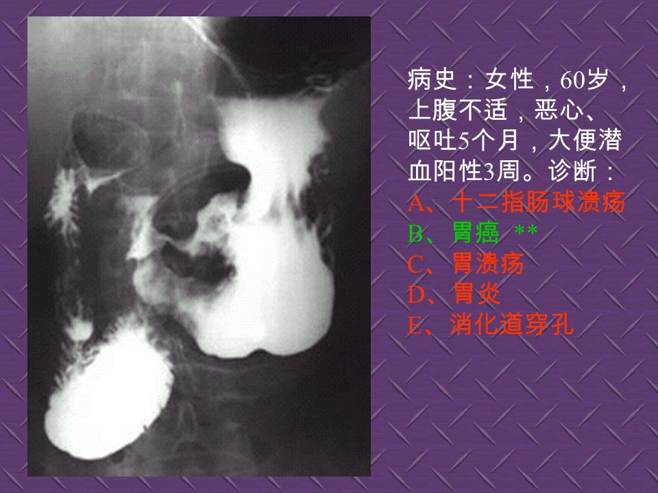 病史：男性， 53 岁，咳嗽、 体重减轻 4 个 月。诊断： A 、左下肺炎 B 、左下包裹性积液 C 、正常胸片 D 、左下肺结核 E 、左下肺癌 **