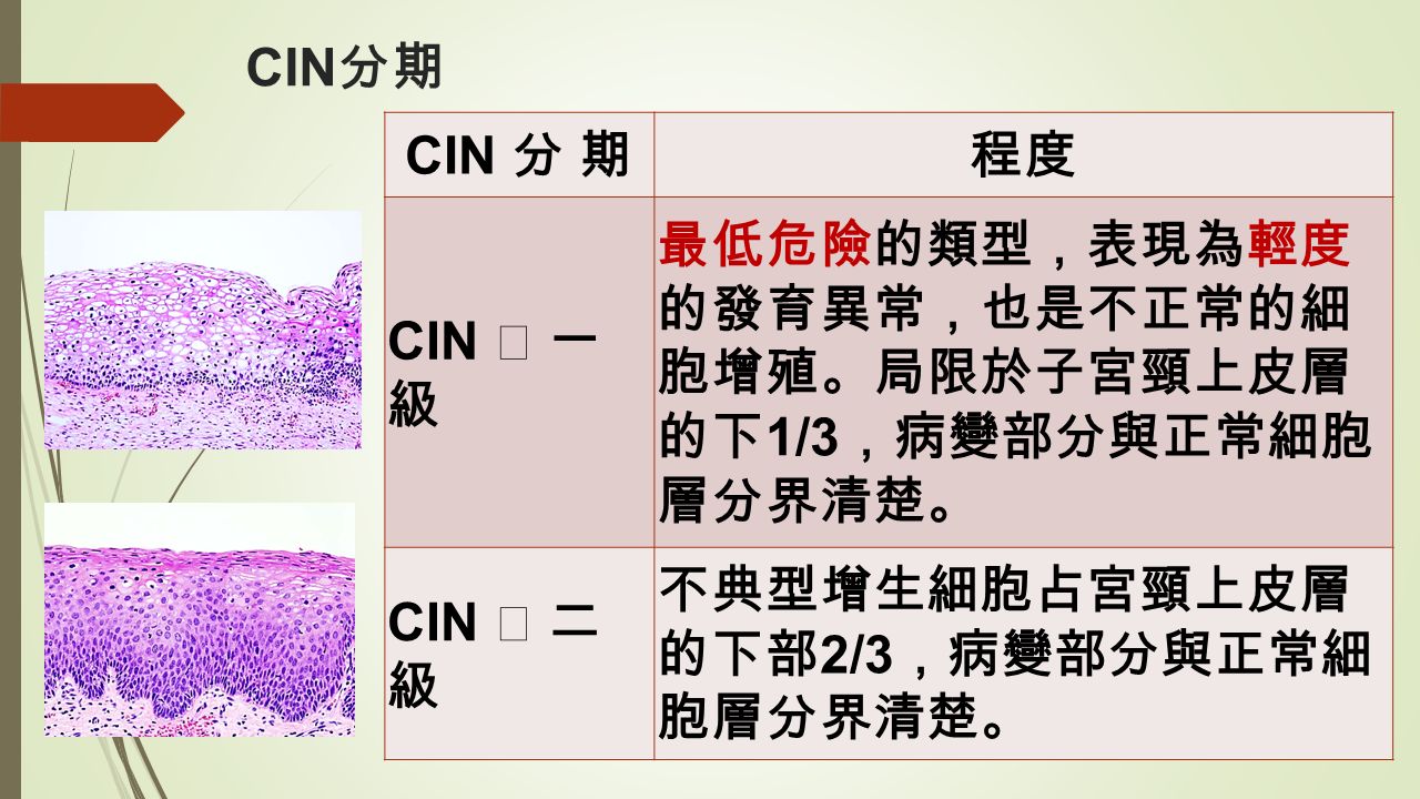 CIN 分期 程度 CIN Ⅰ 一 級 最低危險的類型 ， 表現為輕度 的發育異常 ， 也是不正常的細 胞增殖 。 局限於子宮頸上皮層 的下 1/3 ， 病變部分與正常細胞 層分界清楚 。 CIN Ⅱ 二 級 不典型增生細胞占宮頸上皮層 的下部 2/3 ， 病變部分與正常細 胞層分界清楚 。