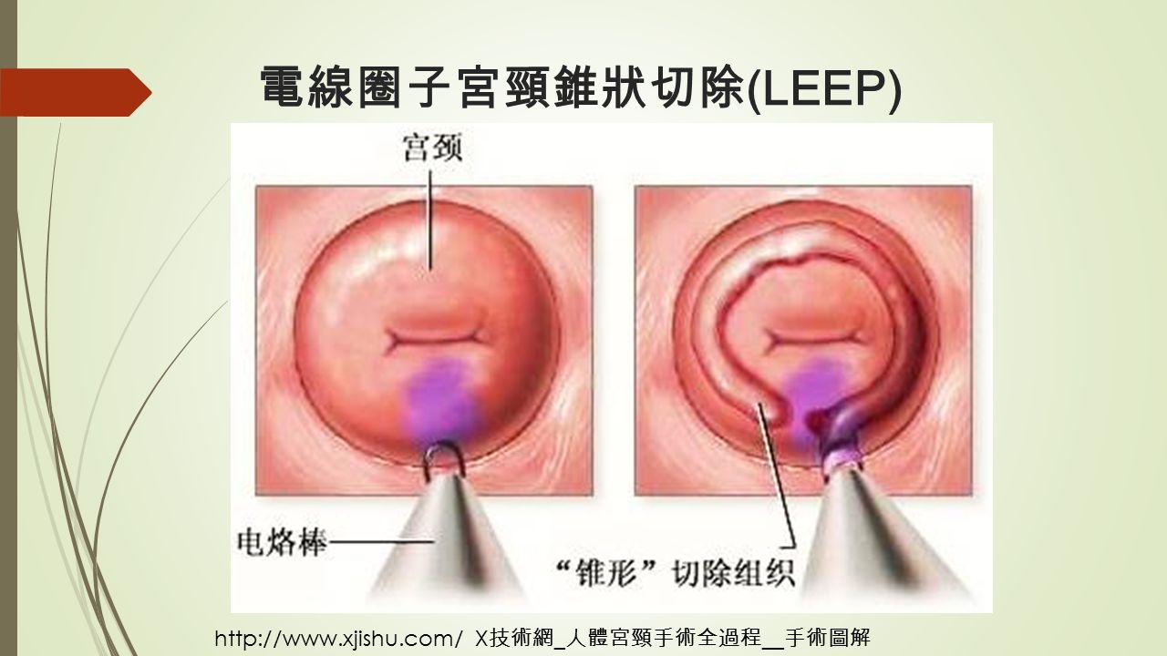 電線圈子宮頸錐狀切除 (LEEP)   X 技術網 _ 人體宮頸手術全過程 __ 手術圖解