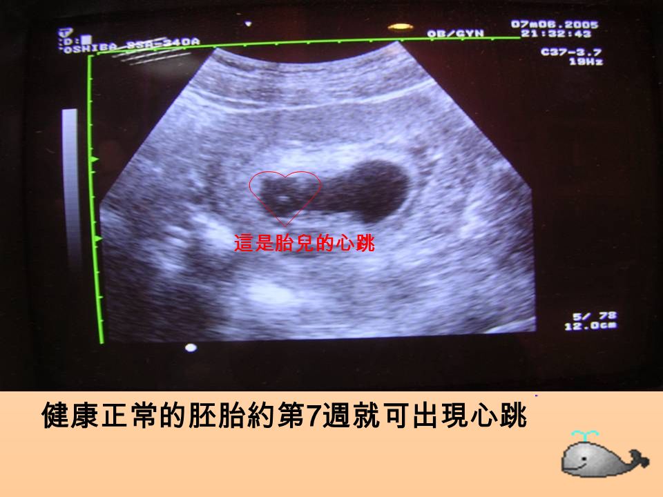 健康正常的胚胎約第 7 週就可出現心跳 這是胎兒的心跳