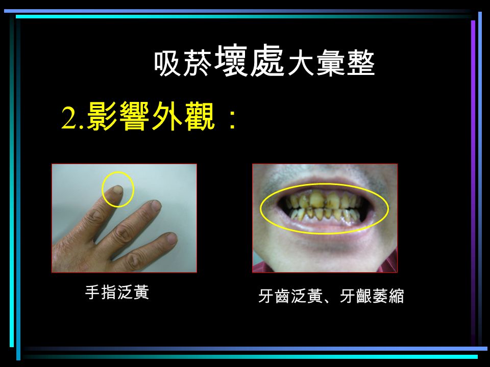 吸菸 壞處 大彙整 2. 影響外觀： 手指泛黃 牙齒泛黃、牙齦萎縮