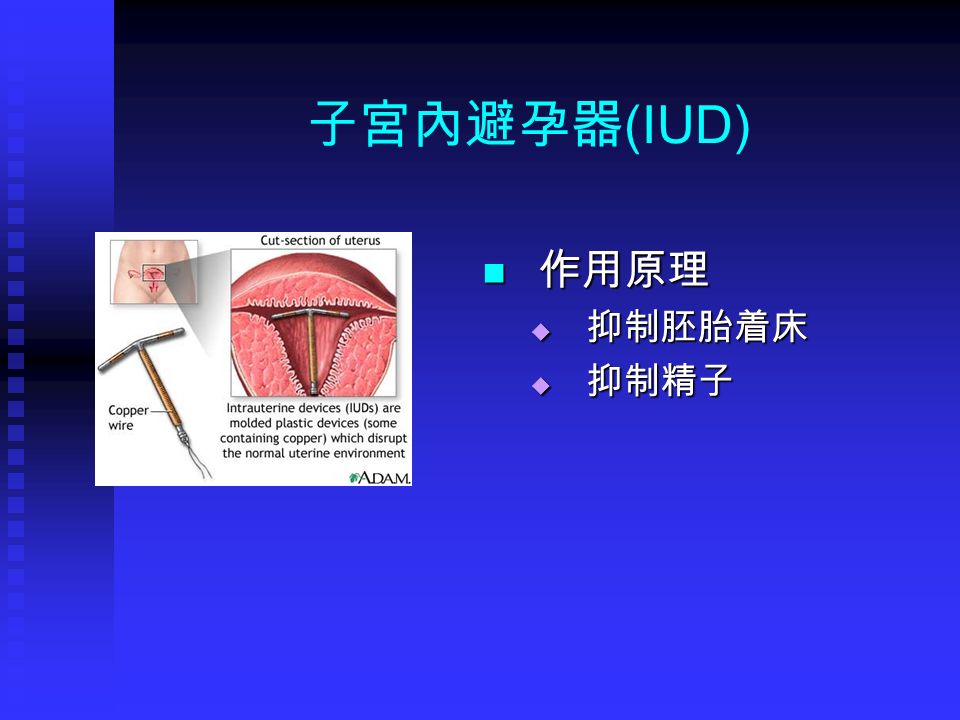 子宮內避孕器 (IUD) 作用原理  抑制胚胎着床  抑制精子
