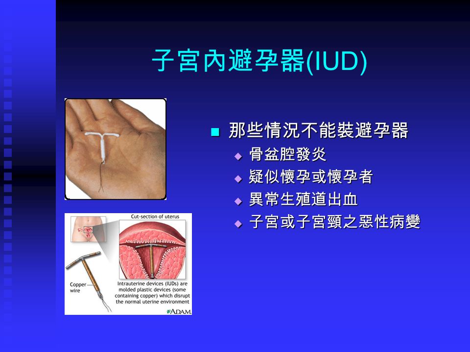 子宮內避孕器 (IUD) 那些情況不能裝避孕器  骨盆腔發炎  疑似懷孕或懷孕者  異常生殖道出血  子宮或子宮頸之惡性病變