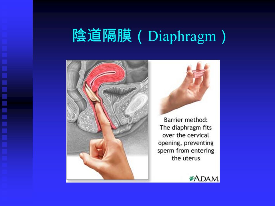 陰道隔膜（ Diaphragm ）