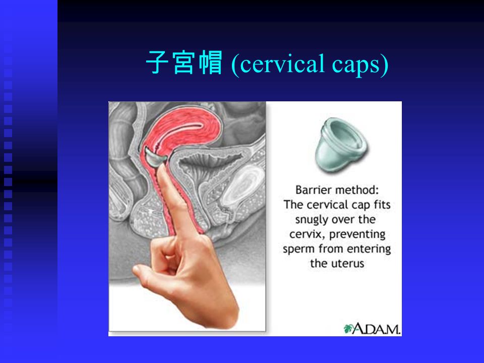 子宮帽 (cervical caps)
