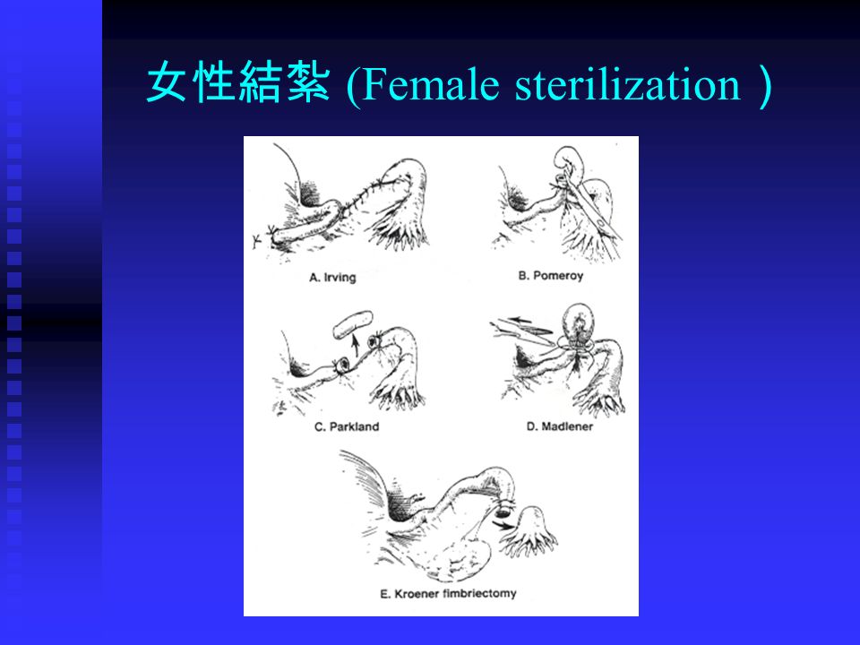 女性結紮 (Female sterilization ）