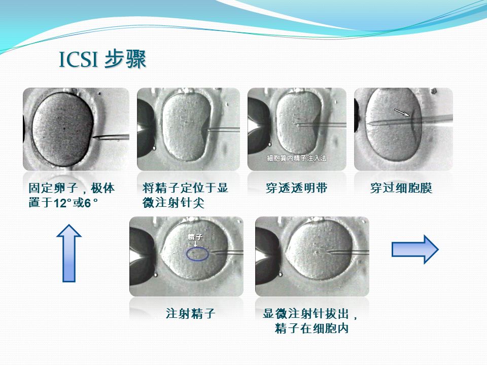 ICSI 步骤 固定卵子，极体 置于 12° 或 6 ° 将精子定位于显 微注射针尖 穿透透明带穿过细胞膜 注射精子显微注射针拔出， 精子在细胞内
