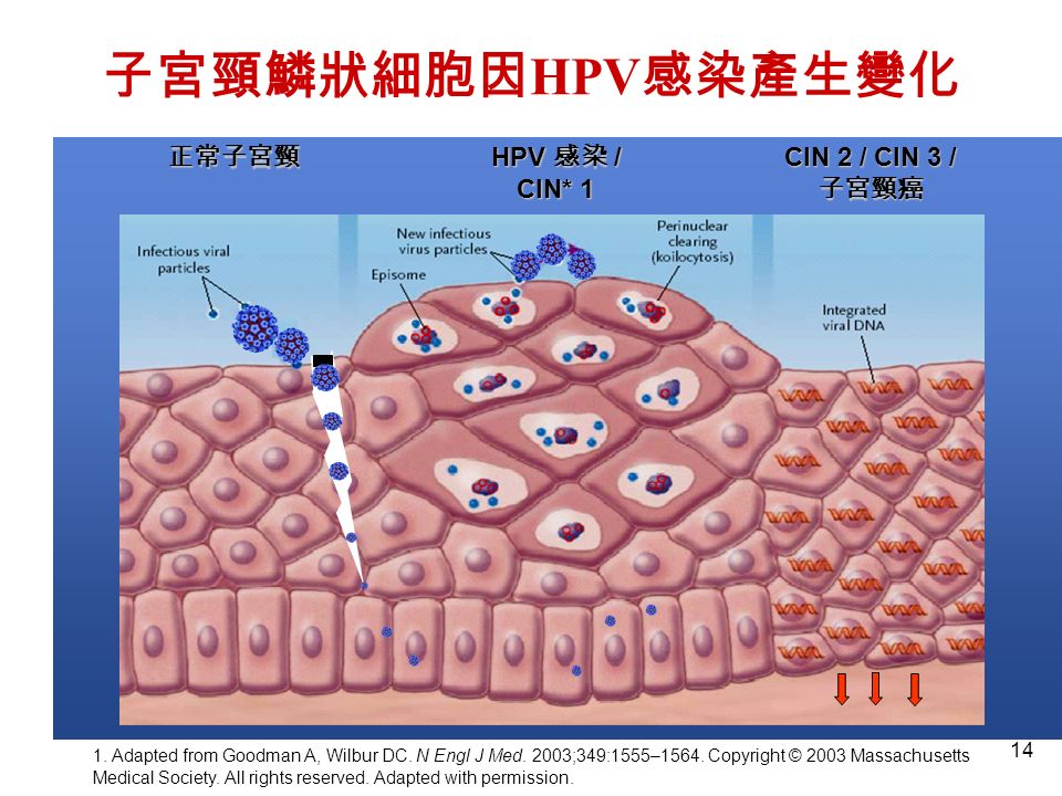 14 子宮頸鱗狀細胞因 HPV 感染產生變化 正常子宮頸 HPV 感染 / CIN* 1 CIN 2 / CIN 3 / 子宮頸癌 1.