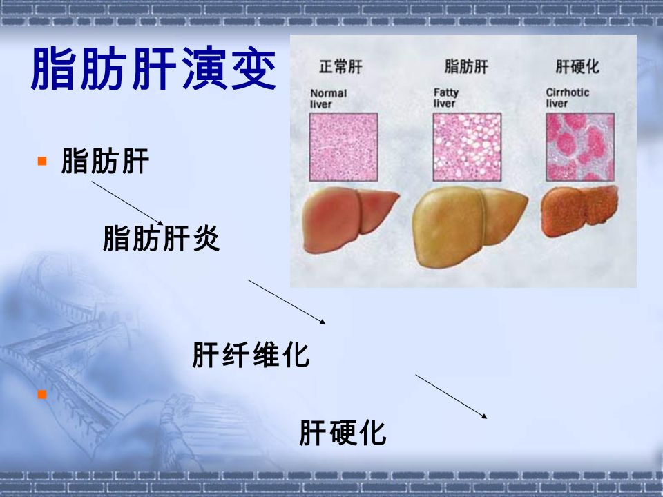 脂肪肝演变  脂肪肝 脂肪肝炎 肝纤维化  肝硬化