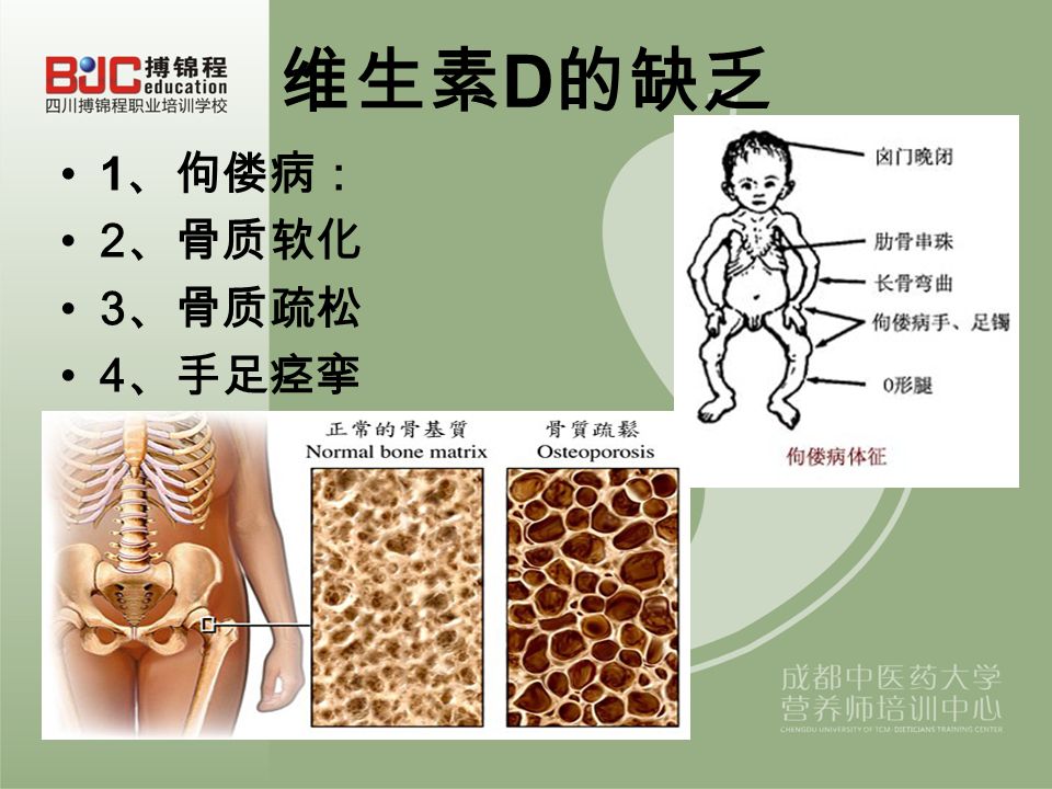 维生素 D 的缺乏 1 、佝偻病： 2 、骨质软化 3 、骨质疏松 4 、手足痉挛