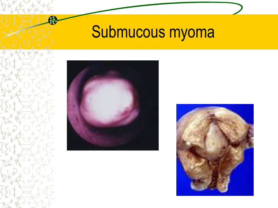 Submucous myoma