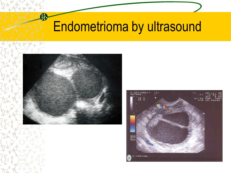 Endometrioma by ultrasound