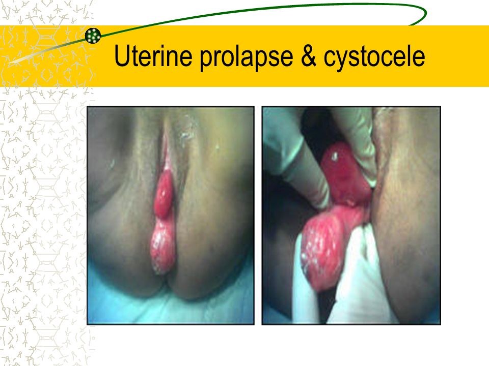 Uterine prolapse & cystocele