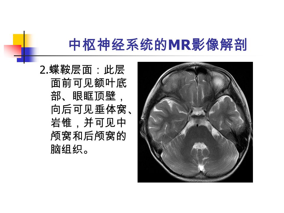 中枢神经系统的 MR 影像解剖 2. 蝶鞍层面：此层 面前可见额叶底 部、眼眶顶壁， 向后可见垂体窝、 岩锥，并可见中 颅窝和后颅窝的 脑组织。