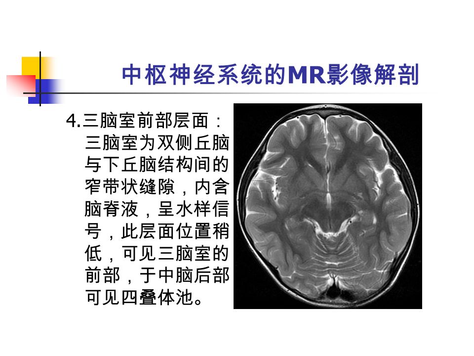 中枢神经系统的 MR 影像解剖 4. 三脑室前部层面： 三脑室为双侧丘脑 与下丘脑结构间的 窄带状缝隙，内含 脑脊液，呈水样信 号，此层面位置稍 低，可见三脑室的 前部，于中脑后部 可见四叠体池。