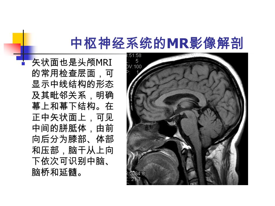 中枢神经系统的 MR 影像解剖 矢状面也是头颅 MRI 的常用检查层面，可 显示中线结构的形态 及其毗邻关系，明确 幕上和幕下结构。在 正中矢状面上，可见 中间的胼胝体，由前 向后分为膝部、体部 和压部，脑干从上向 下依次可识别中脑、 脑桥和延髓。