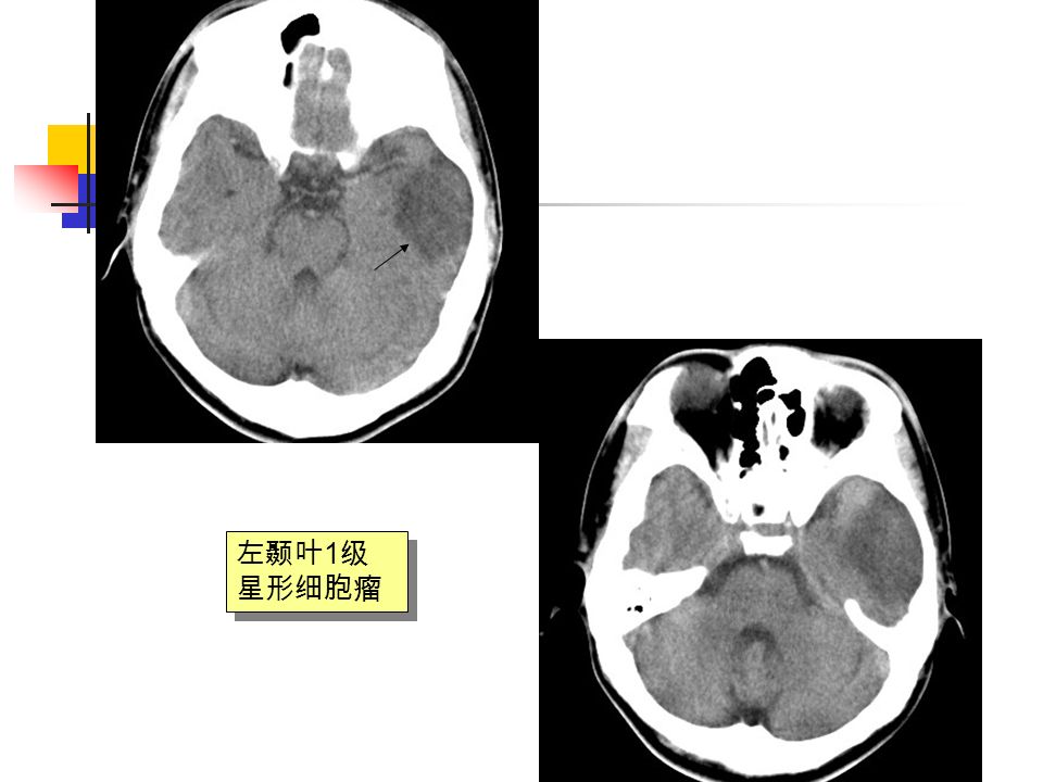 左颞叶 1 级 星形细胞瘤