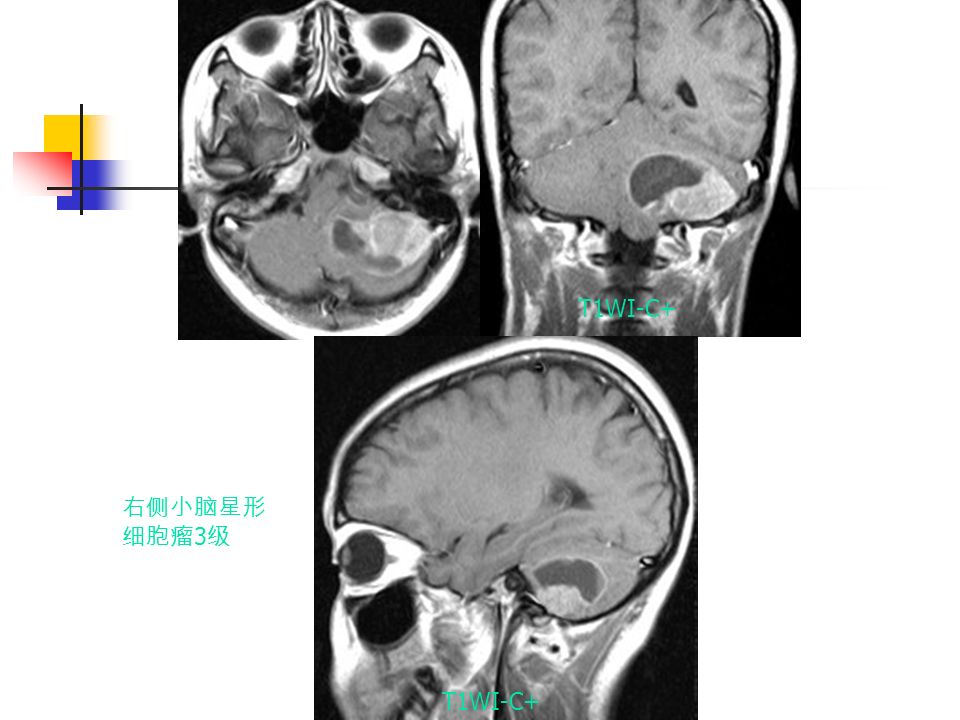 右侧小脑星形 细胞瘤 3 级 T1WI-C+