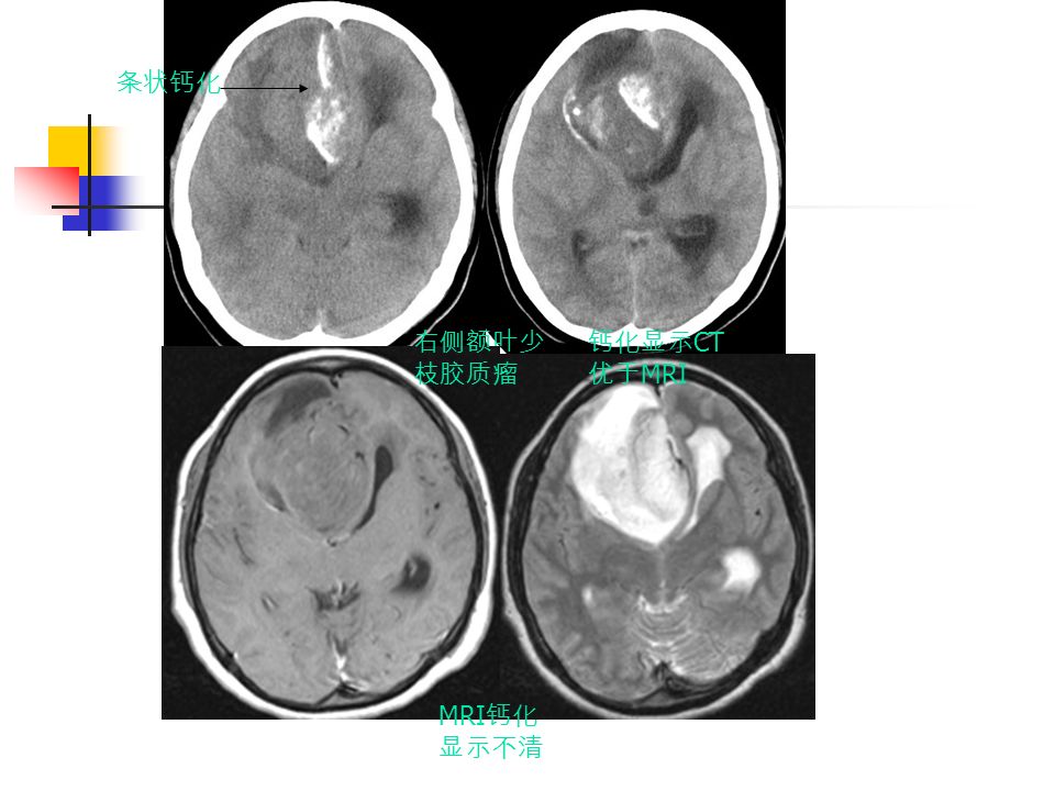 右侧额叶少 枝胶质瘤 条状钙化 钙化显示 CT 优于 MRI MRI 钙化 显示不清