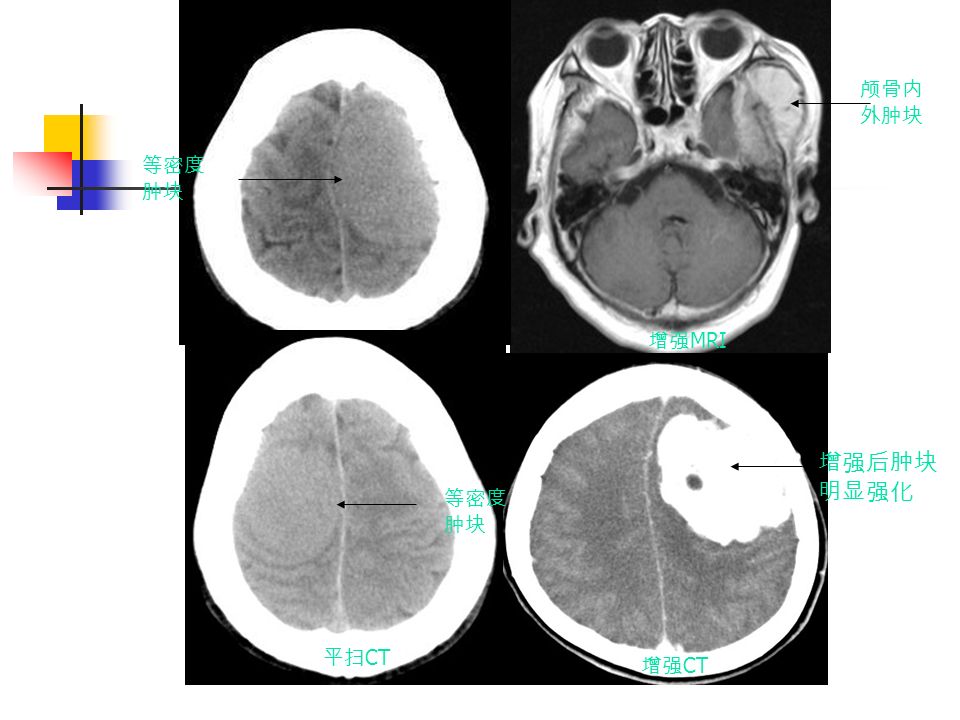 增强后肿块 明显强化 等密度 肿块 颅骨内 外肿块 增强 CT 增强 MRI 平扫 CT