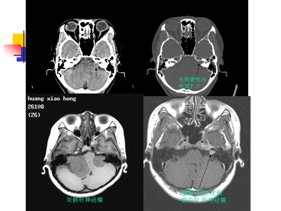 左侧骨性内 听道扩大 增强 MRI 示左侧 管内段 听神经瘤 双侧听神经瘤
