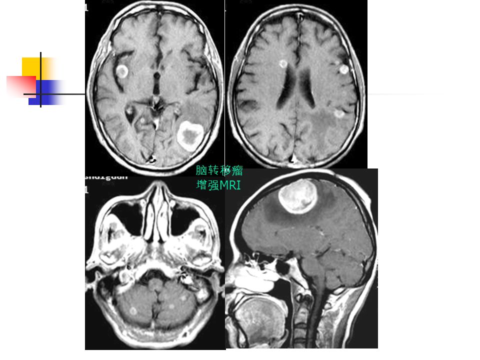脑转移瘤 增强 MRI