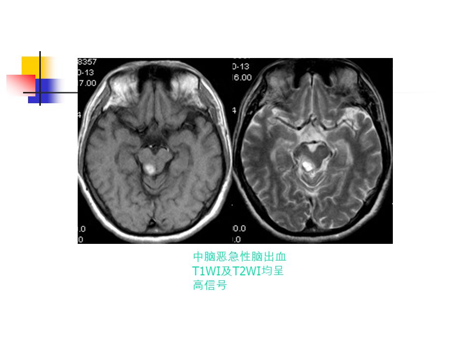 中脑恶急性脑出血 T1WI 及 T2WI 均呈 高信号
