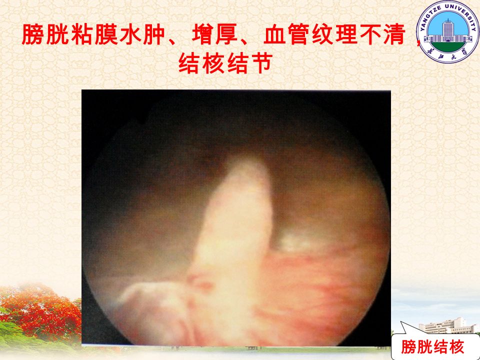 膀胱粘膜水肿、增厚、血管纹理不清， 结核结节 膀胱结核