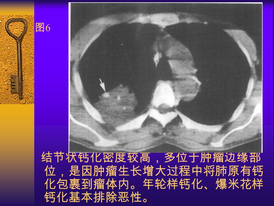 图6图6 结节状钙化密度较高，多位于肿瘤边缘部 位，是因肿瘤生长增大过程中将肺原有钙 化包裹到瘤体内。年轮样钙化、爆米花样 钙化基本排除恶性。