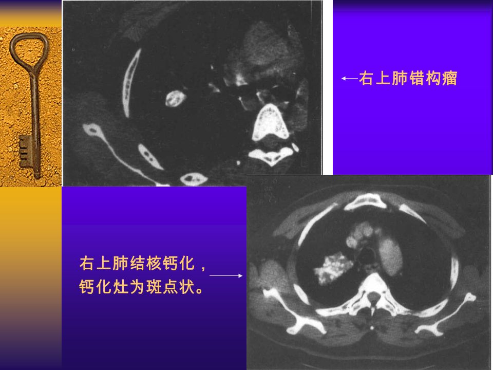 图 15 右上肺错构瘤 右上肺结核钙化， 钙化灶为斑点状。