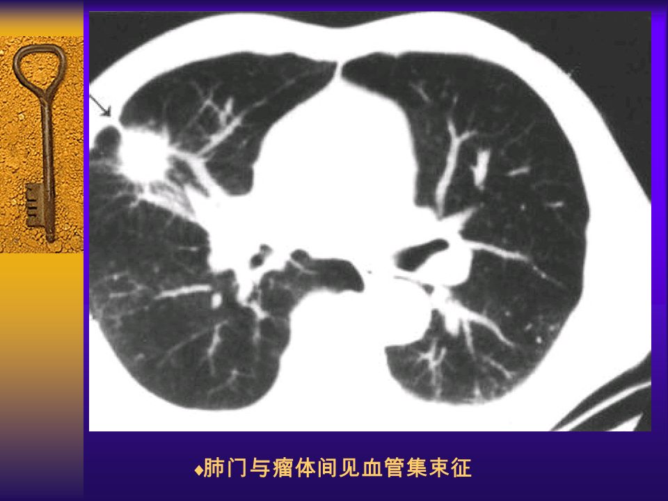 图 27 邻近血管支气管改变  肺门与瘤体间见血管集束征