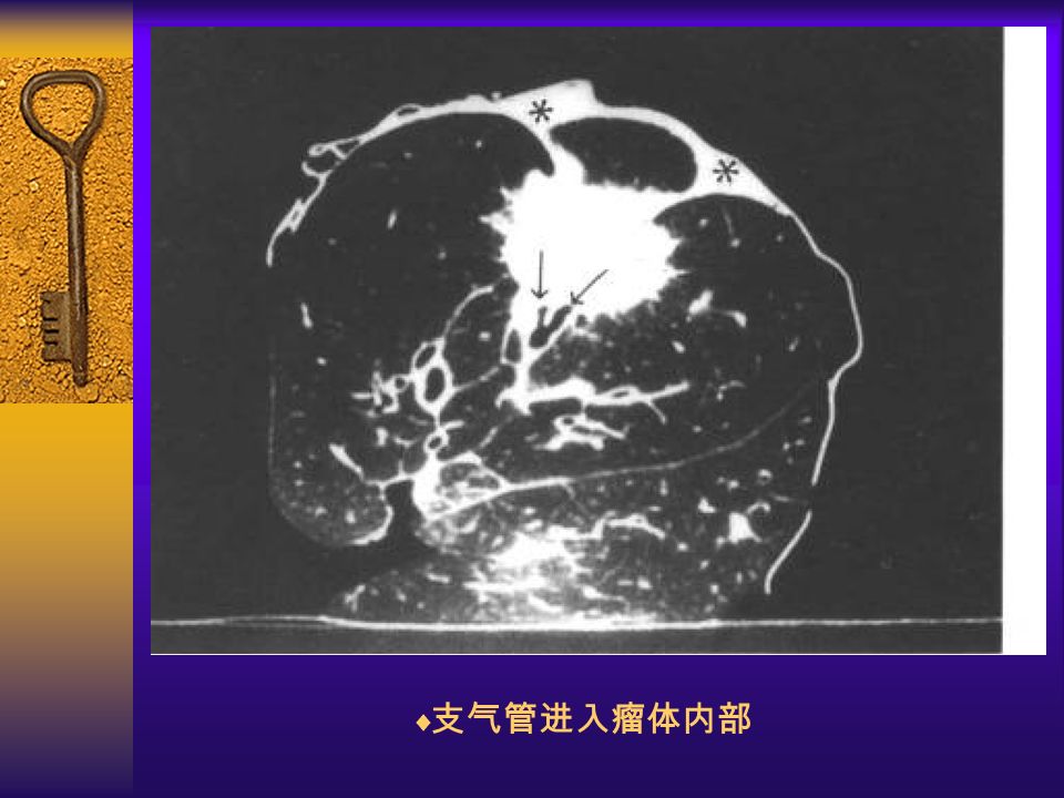 图 29  支气管进入瘤体内部