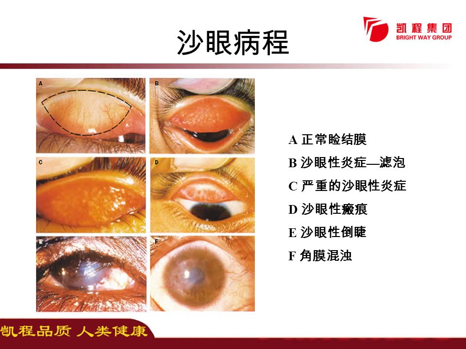 A 正常睑结膜 B 沙眼性炎症 — 滤泡 C 严重的沙眼性炎症 D 沙眼性瘢痕 E 沙眼性倒睫 F 角膜混浊 沙眼病程