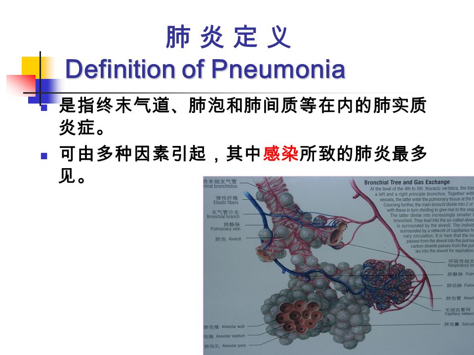 Definition of Pneumonia 肺 炎 定 义 Definition of Pneumonia 是指终末气道、肺泡和肺间质等在内的肺实质 炎症。 可由多种因素引起，其中感染所致的肺炎最多 见。