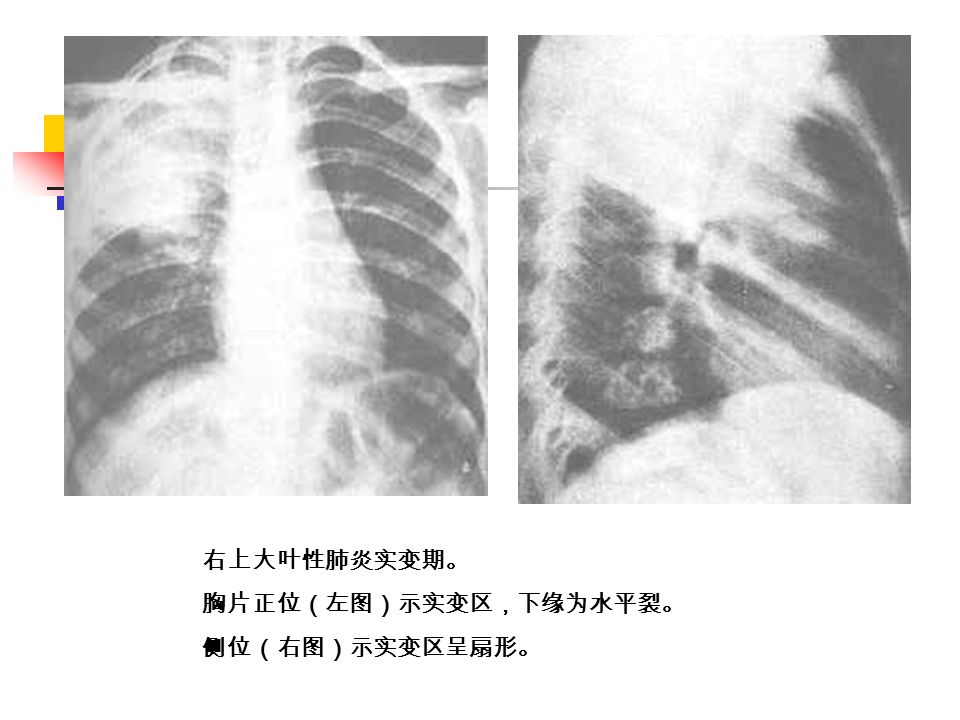 右上大叶性肺炎实变期。 胸片正位（左图）示实变区，下缘为水平裂。 侧位（右图）示实变区呈扇形。