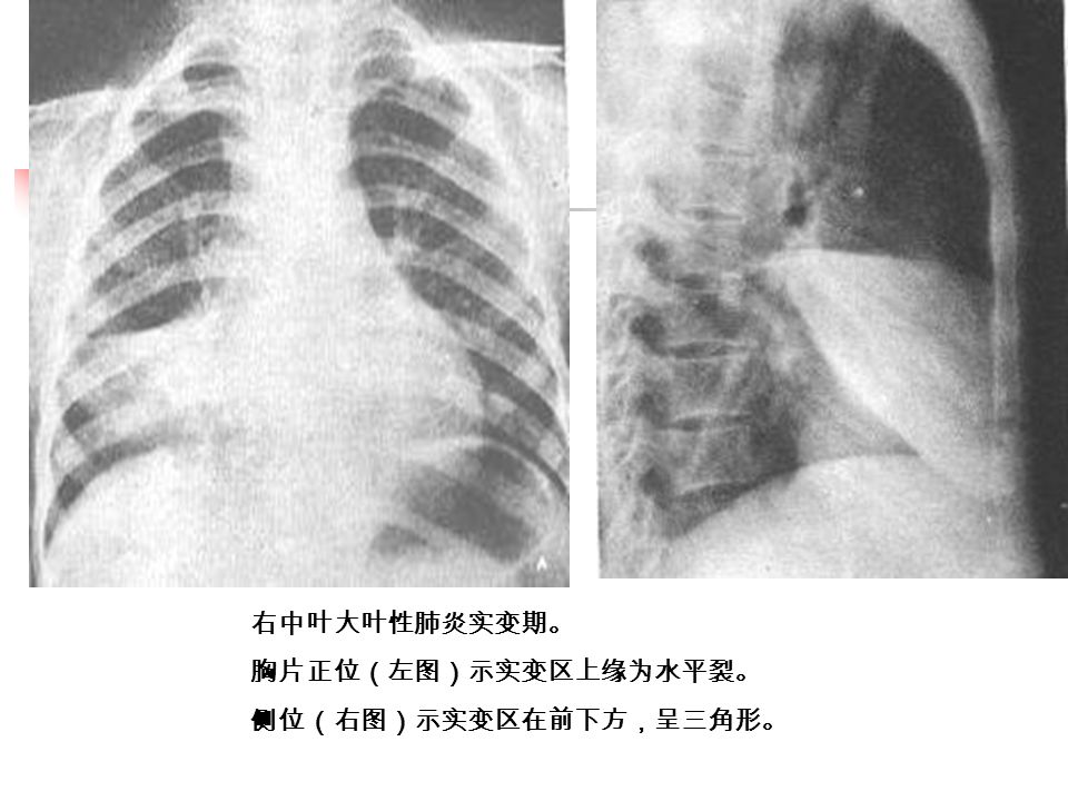 右中叶大叶性肺炎实变期。 胸片正位（左图）示实变区上缘为水平裂。 侧位（右图）示实变区在前下方，呈三角形。