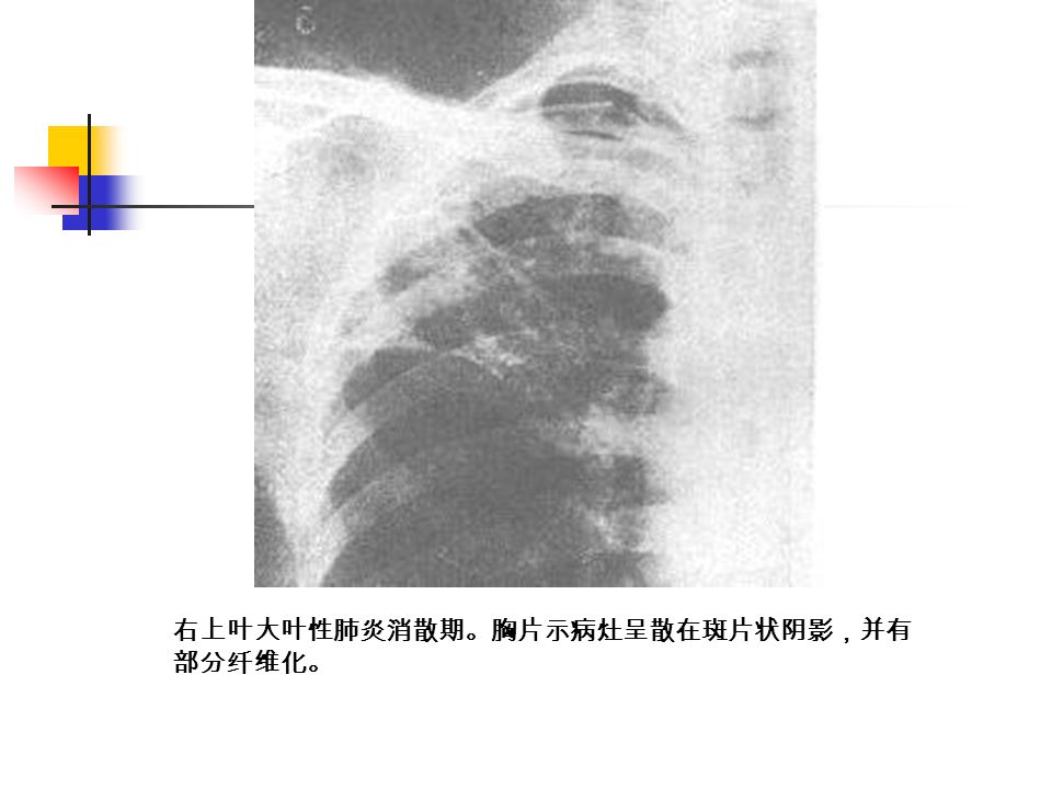 右上叶大叶性肺炎消散期。胸片示病灶呈散在斑片状阴影，并有 部分纤维化。