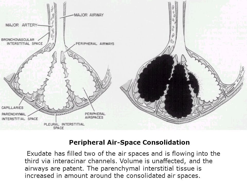 Peripheral Air-Space Consolidation Exudate has filled two of the air spaces and is flowing into the third via interacinar channels.